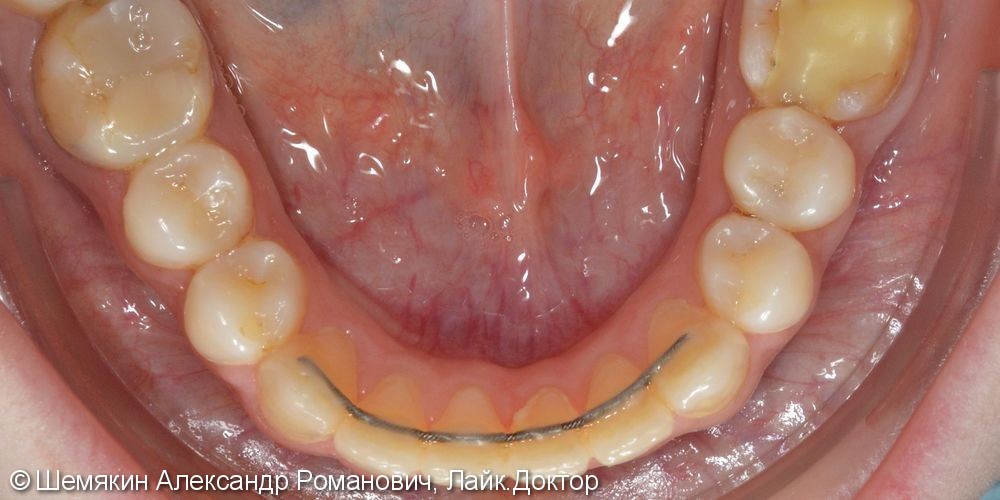 Исправление дистального прикуса лингвальными брекетами, до и после - фото №9