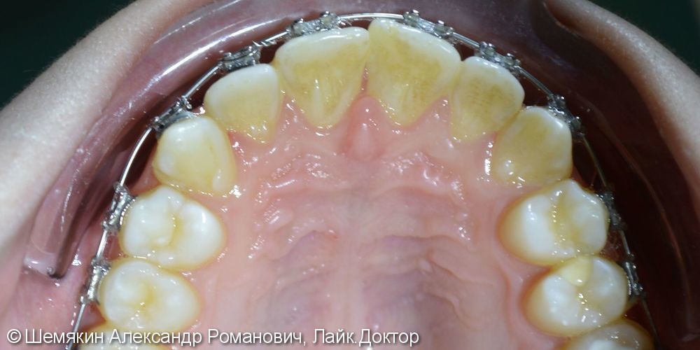 Ортодонтическое лечение на несъёмной технике Orthos, до и после - фото №2