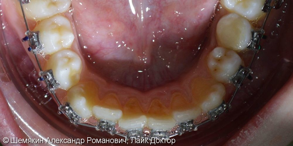 Ортодонтическое лечение на несъёмной технике Orthos, до и после - фото №3