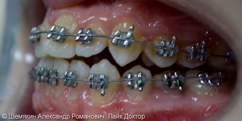 Ортодонтическое лечение на несъёмной технике Orthos, до и после - фото №4