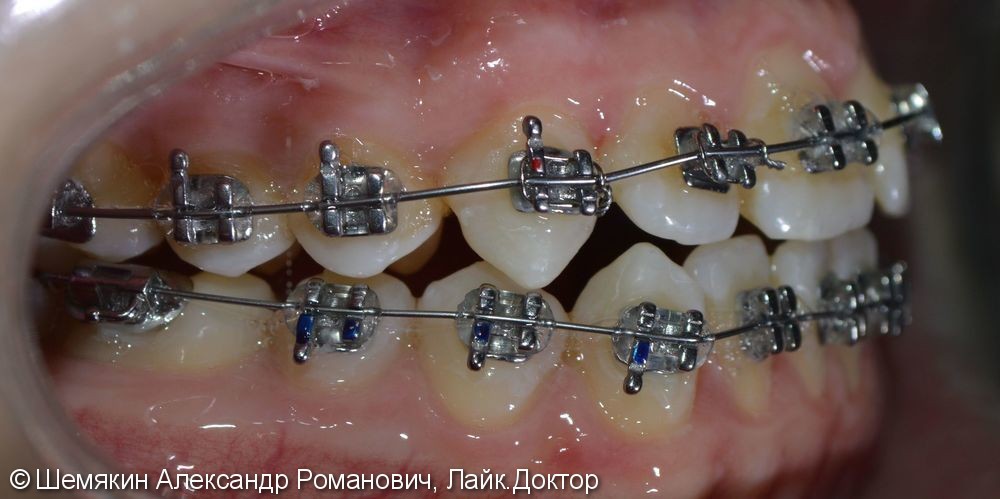 Ортодонтическое лечение на несъёмной технике Orthos, до и после - фото №5