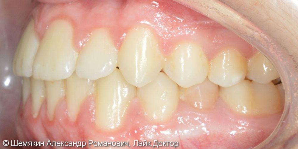 Ортодонтическое лечение на несъёмной технике Orthos, до и после - фото №6