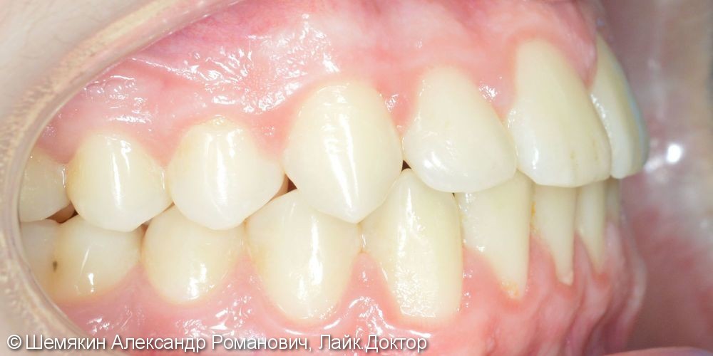 Ортодонтическое лечение на несъёмной технике Orthos, до и после - фото №7