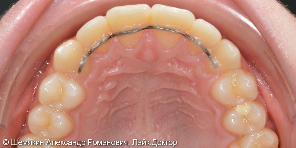 Ортодонтическое лечение на несъёмной технике Orthos, до и после - фото №8