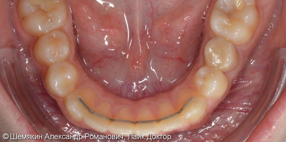 Ортодонтическое лечение на несъёмной технике Orthos, до и после - фото №9