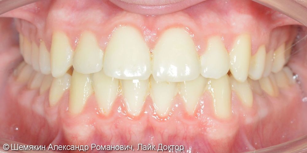 Ортодонтическое лечение на несъёмной технике Orthos, до и после - фото №10
