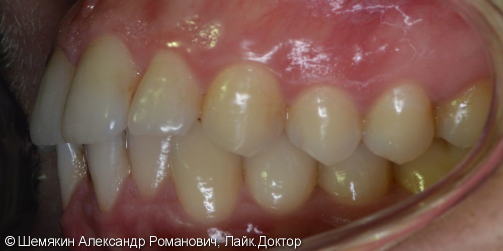 Ортодонтическое лечение на несъёмной лингвальной технике WIN, до и после - фото №2