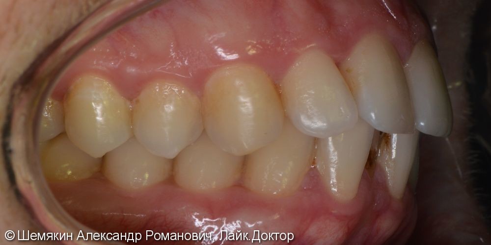 Ортодонтическое лечение на несъёмной лингвальной технике WIN, до и после - фото №3