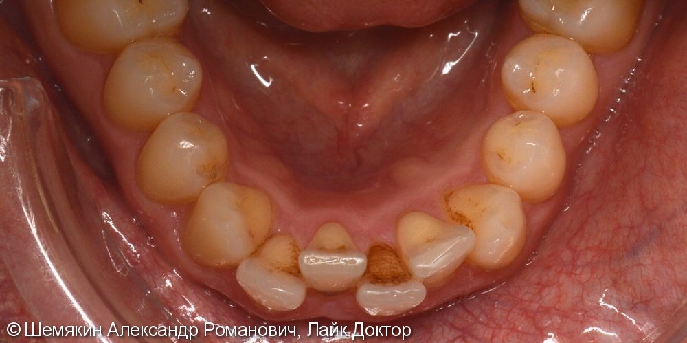 Ортодонтическое лечение на несъёмной лингвальной технике WIN, до и после - фото №4
