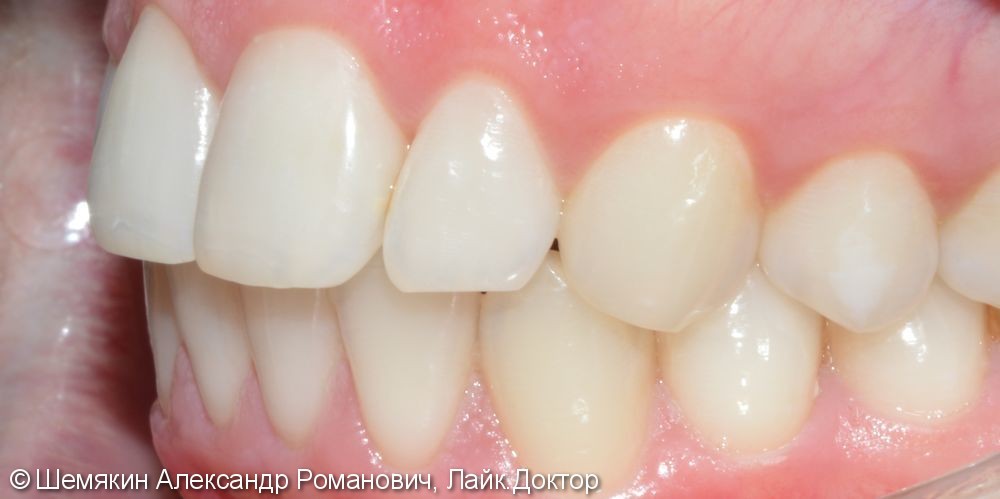 Ортодонтическое лечение на несъёмной лингвальной технике WIN, до и после - фото №5