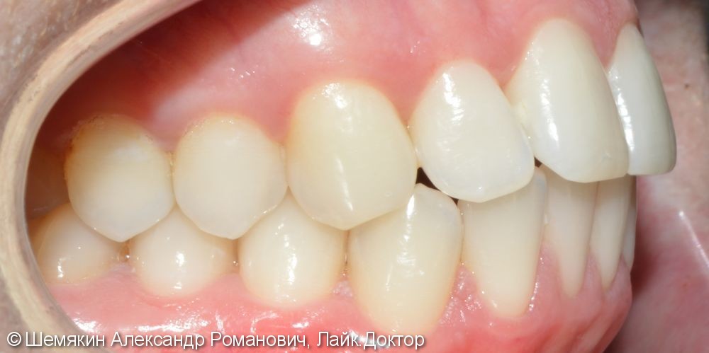 Ортодонтическое лечение на несъёмной лингвальной технике WIN, до и после - фото №6