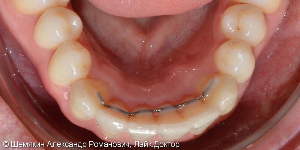 Ортодонтическое лечение на несъёмной лингвальной технике WIN, до и после - фото №7