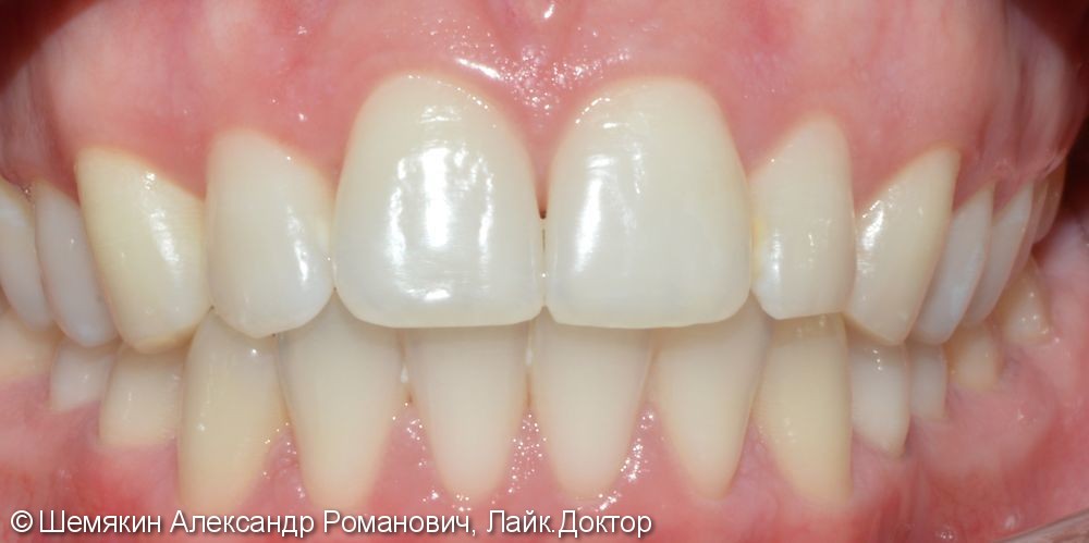 Ортодонтическое лечение на несъёмной лингвальной технике WIN, до и после - фото №8