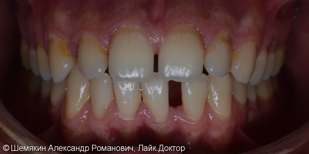 Ортодонтическое лечение на несъёмной технике Damon Q, до и после - фото №1