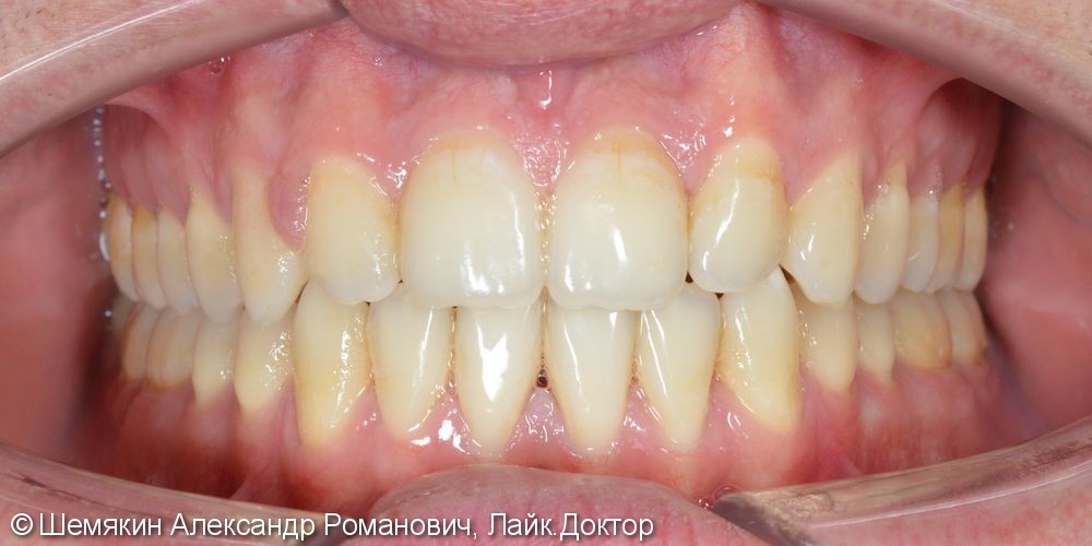 Ортодонтическое лечение на несъёмной технике Damon Q, до и после - фото №10