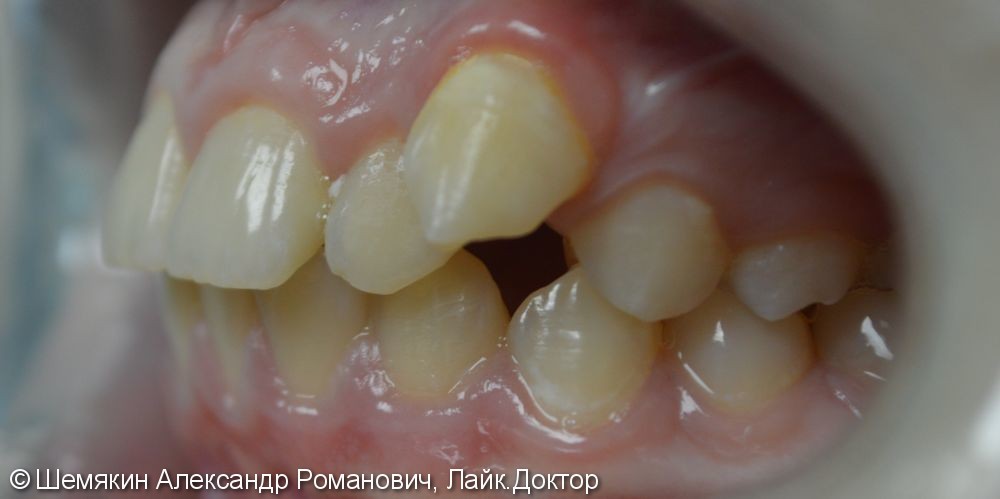 Нейтральное соотношение апикальных базисов, дистальное соотношение зубных рядов - фото №4