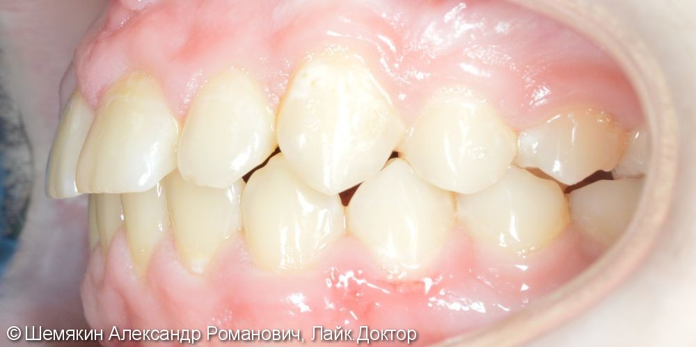 Нейтральное соотношение апикальных базисов, дистальное соотношение зубных рядов - фото №7
