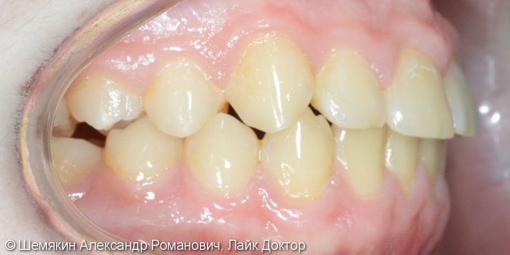 Нейтральное соотношение апикальных базисов, дистальное соотношение зубных рядов - фото №8