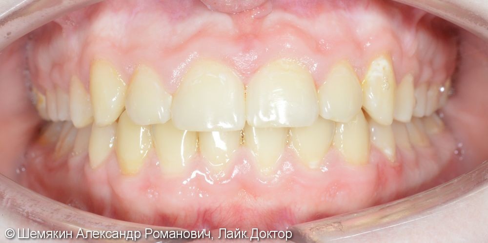 Нейтральное соотношение апикальных базисов, дистальное соотношение зубных рядов - фото №9