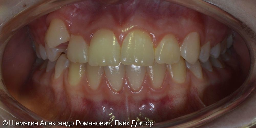 Дефицит места зубу 1.3, сагиттальная щель 2-3 мм, до и после - фото №1