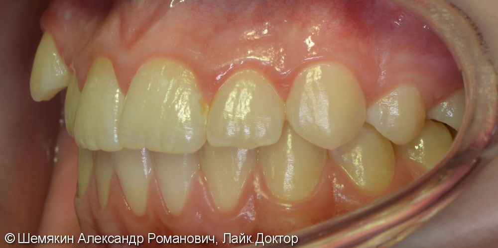 Дефицит места зубу 1.3, сагиттальная щель 2-3 мм, до и после - фото №2