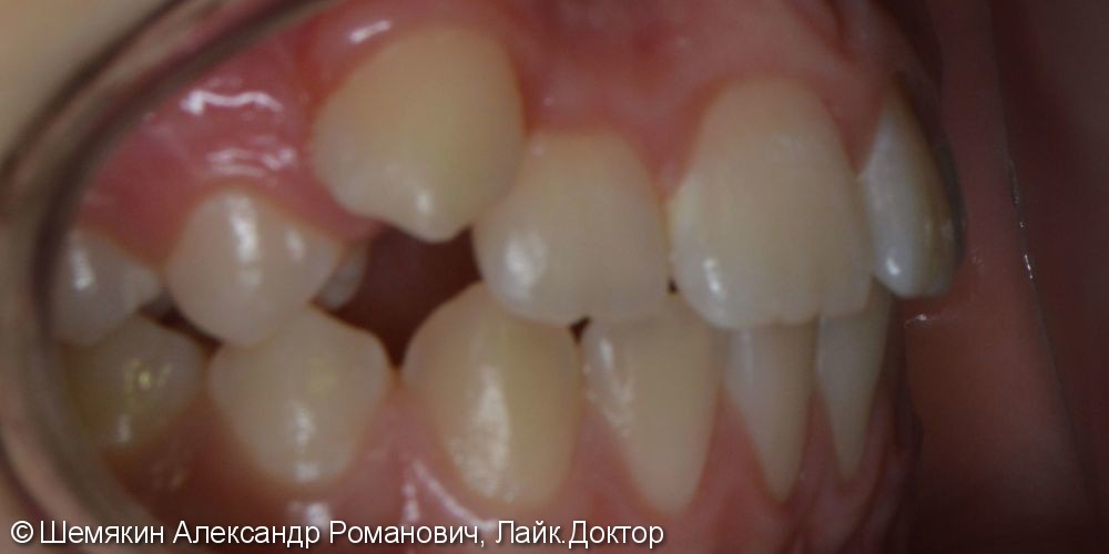 Дефицит места зубу 1.3, сагиттальная щель 2-3 мм, до и после - фото №3