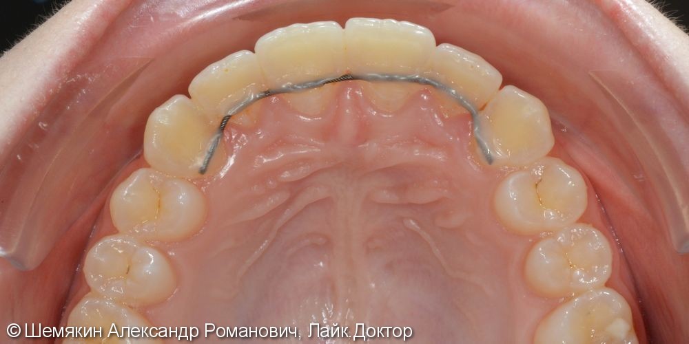 Дефицит места зубу 1.3, сагиттальная щель 2-3 мм, до и после - фото №4