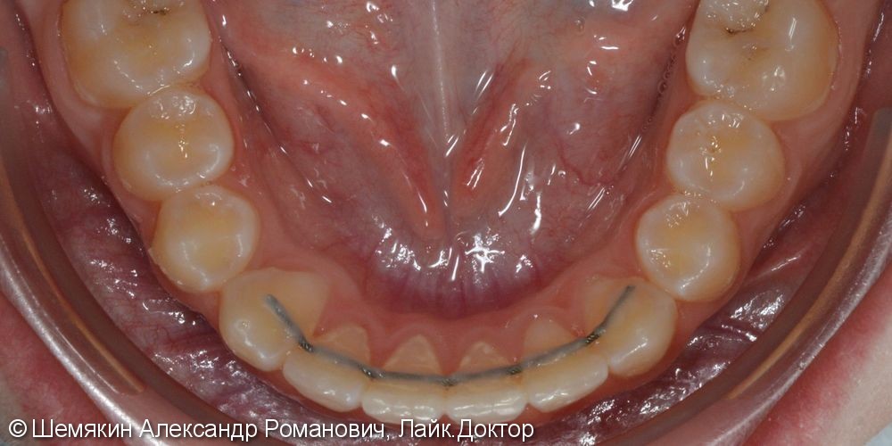 Дефицит места зубу 1.3, сагиттальная щель 2-3 мм, до и после - фото №5