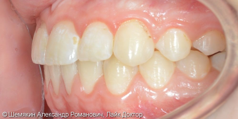 Дефицит места зубу 1.3, сагиттальная щель 2-3 мм, до и после - фото №6