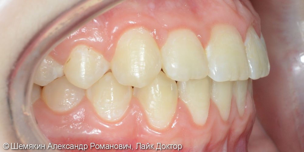 Дефицит места зубу 1.3, сагиттальная щель 2-3 мм, до и после - фото №7