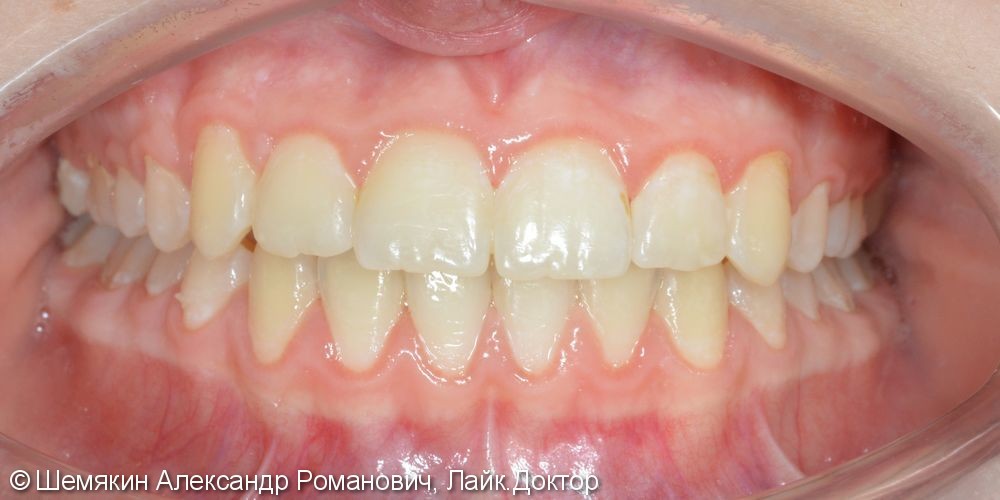 Дефицит места зубу 1.3, сагиттальная щель 2-3 мм, до и после - фото №8