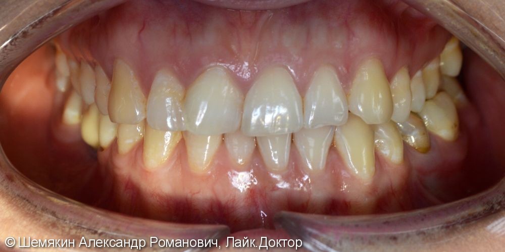 Ортодонтическое лечение на несъёмной технике Damon Q, межчелюстные эластики по 2 классу слева - фото №1