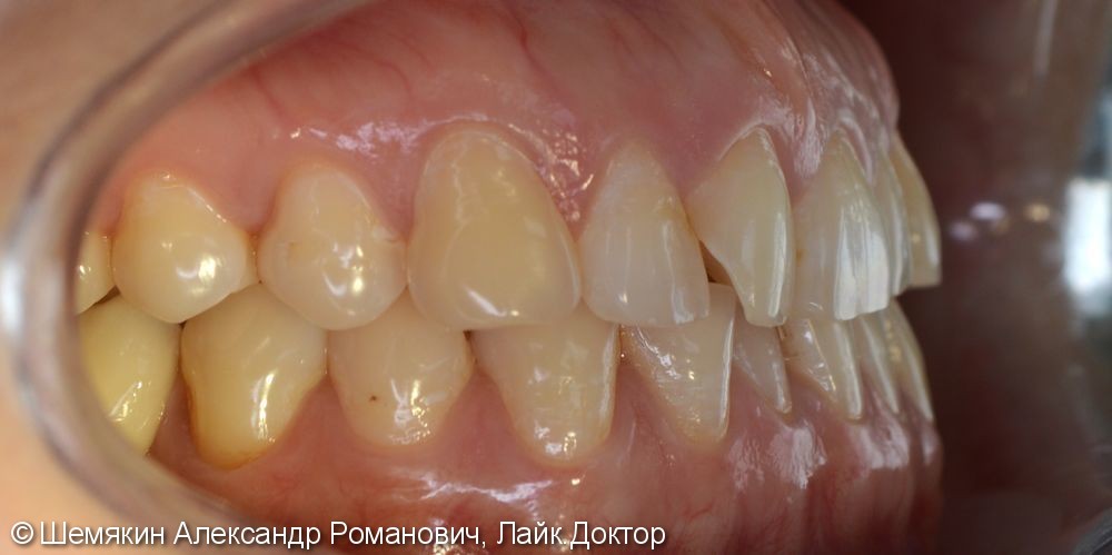 Ортодонтическое лечение на несъёмной технике Damon Q, межчелюстные эластики по 2 классу слева - фото №2