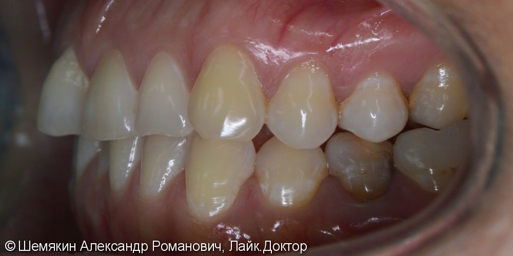 Ортодонтическое лечение на несъёмной технике Damon Q, межчелюстные эластики по 2 классу слева - фото №3