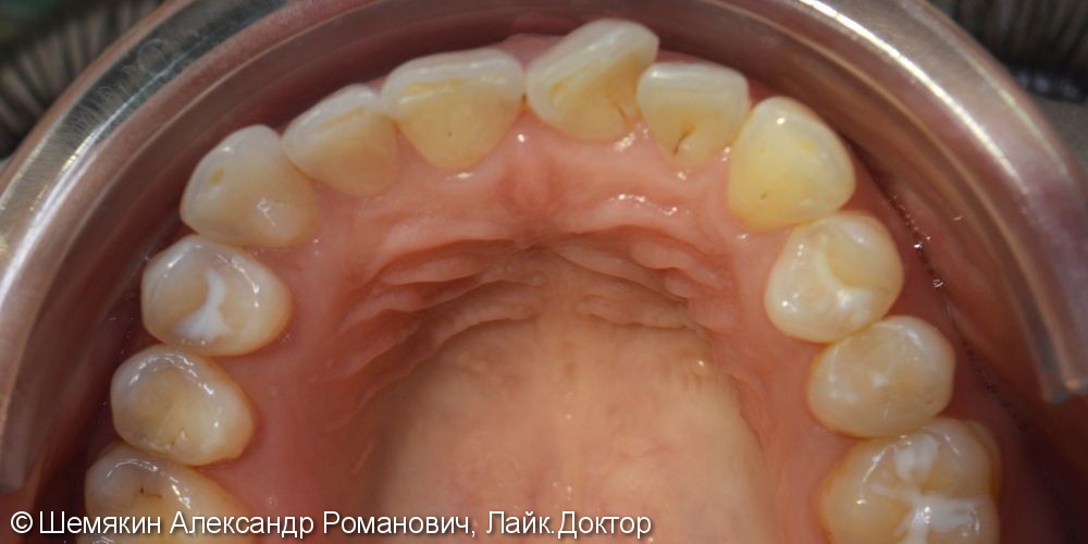 Ортодонтическое лечение на несъёмной технике Damon Q, межчелюстные эластики по 2 классу слева - фото №4