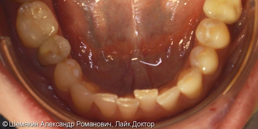 Ортодонтическое лечение на несъёмной технике Damon Q, межчелюстные эластики по 2 классу слева - фото №5