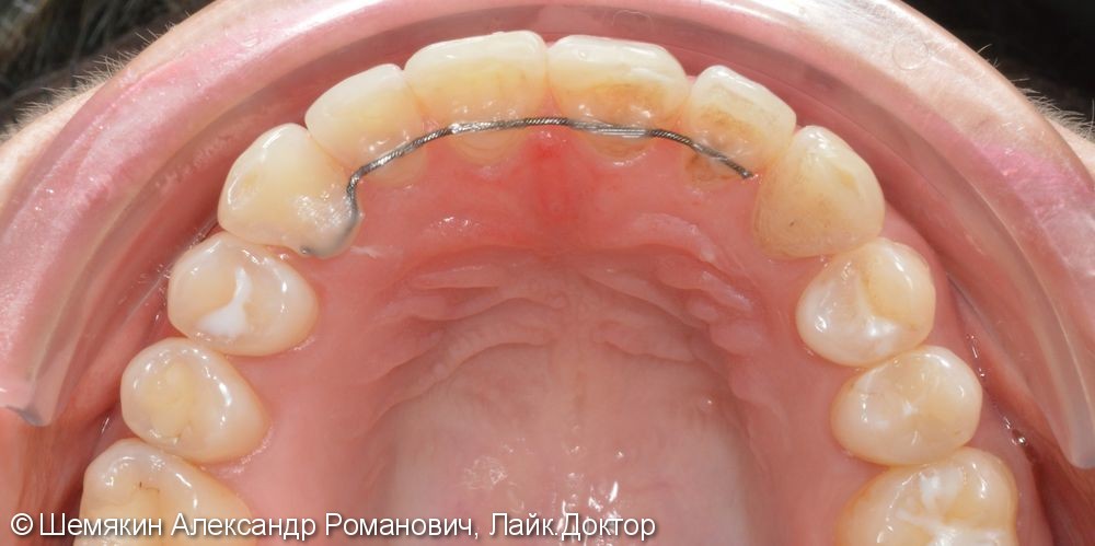 Ортодонтическое лечение на несъёмной технике Damon Q, межчелюстные эластики по 2 классу слева - фото №6