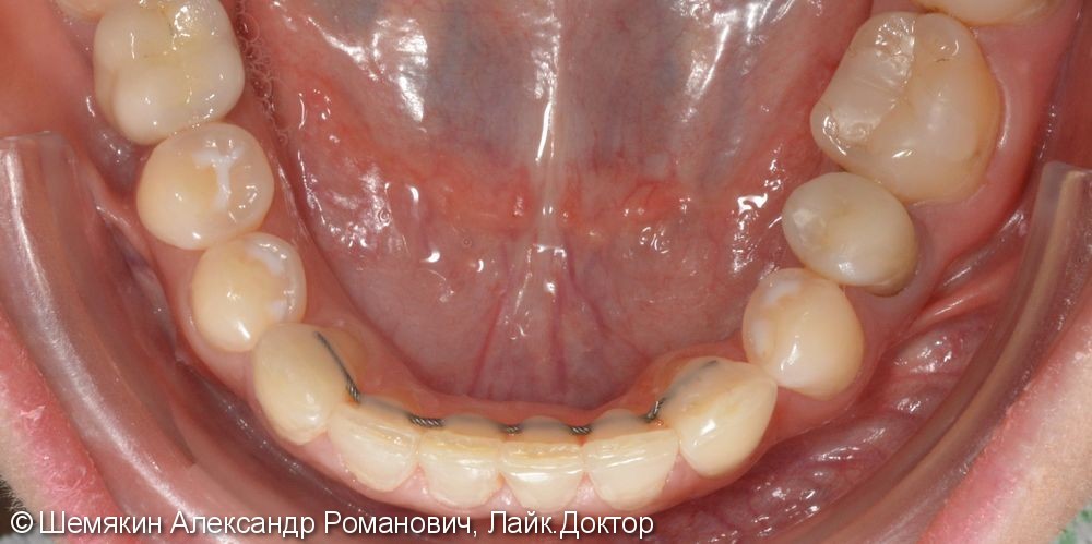 Ортодонтическое лечение на несъёмной технике Damon Q, межчелюстные эластики по 2 классу слева - фото №7