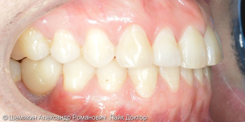 Ортодонтическое лечение на несъёмной технике Damon Q, межчелюстные эластики по 2 классу слева - фото №8