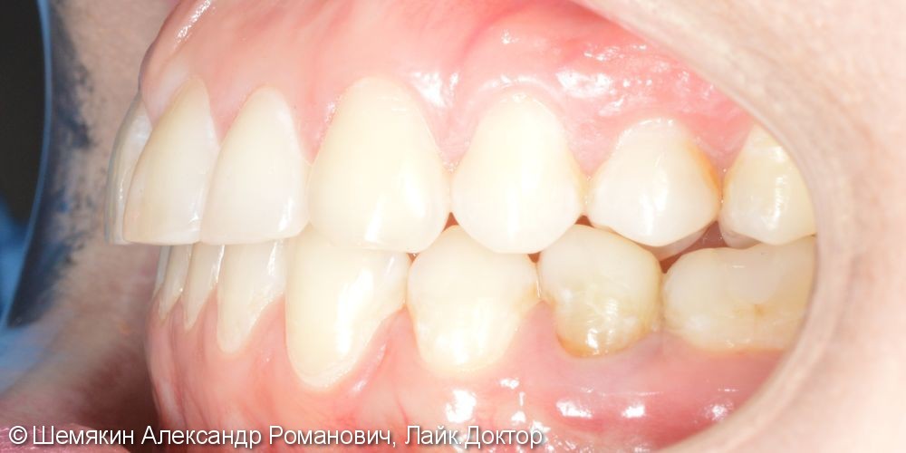 Ортодонтическое лечение на несъёмной технике Damon Q, межчелюстные эластики по 2 классу слева - фото №9