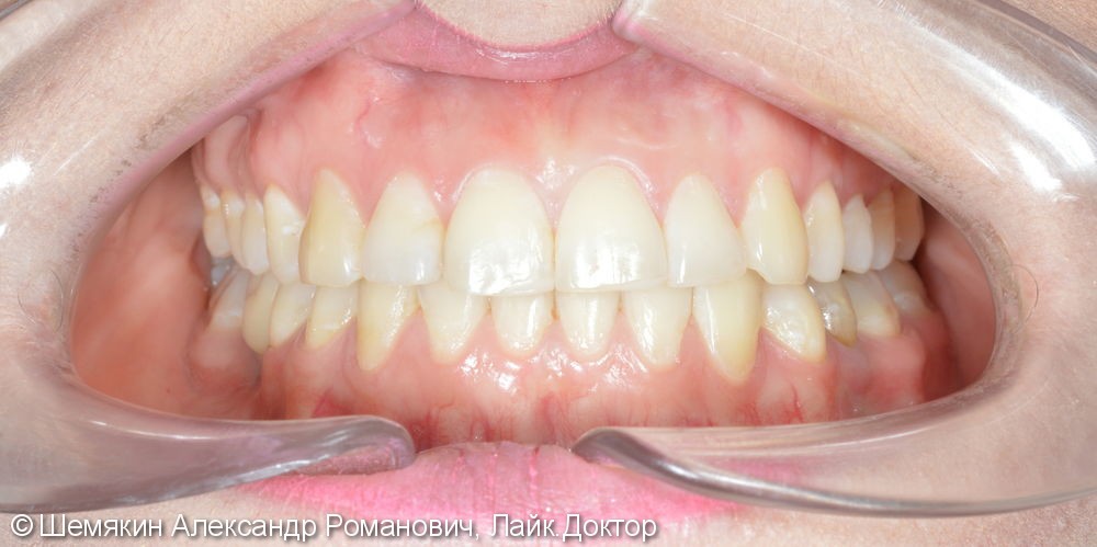 Ортодонтическое лечение на несъёмной технике Damon Q, межчелюстные эластики по 2 классу слева - фото №10