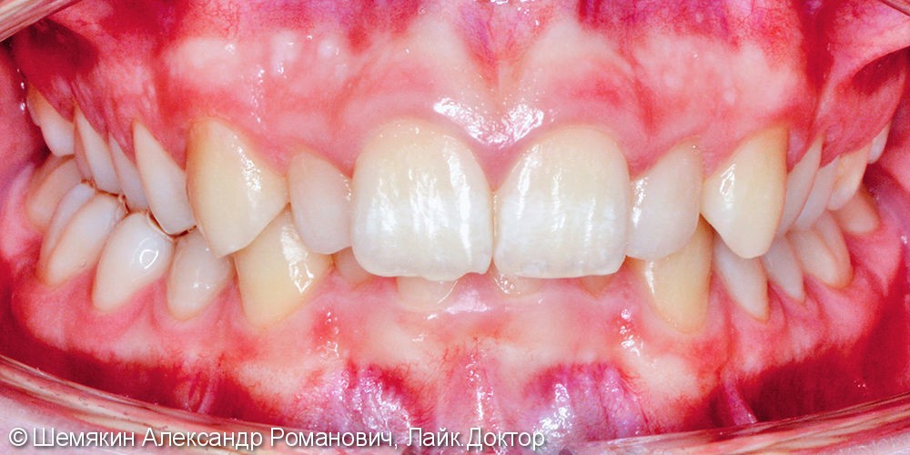 Исправление скученности зубов брекет системой Damon Q, до и результат после - фото №1