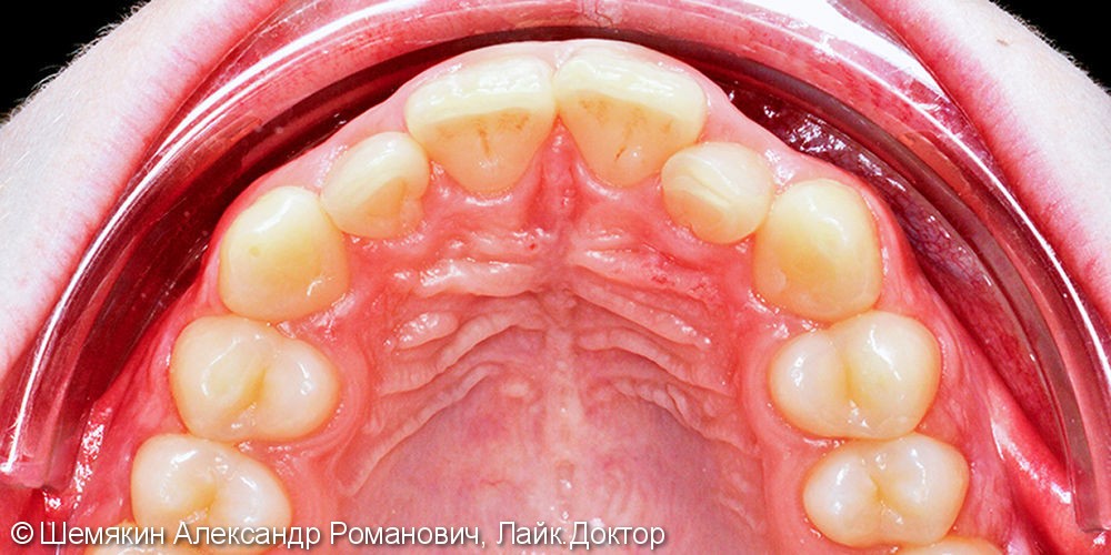 Исправление скученности зубов брекет системой Damon Q, до и результат после - фото №2