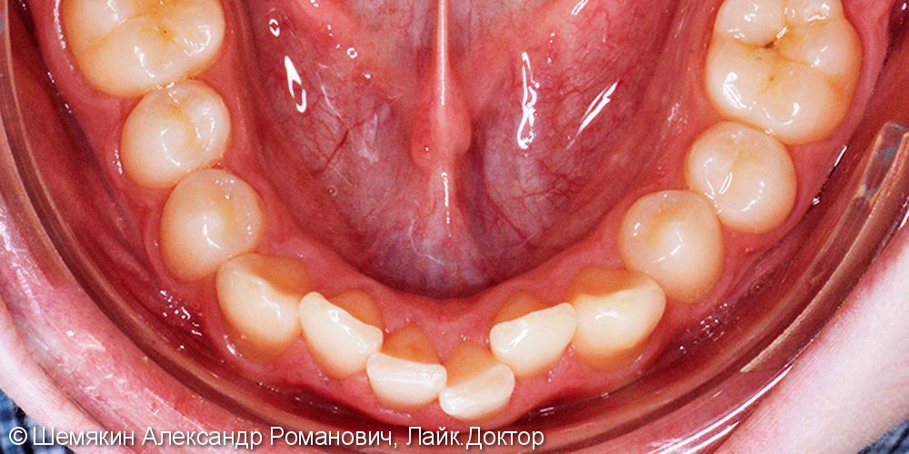 Исправление скученности зубов брекет системой Damon Q, до и результат после - фото №3