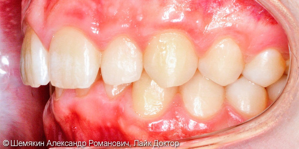 Исправление скученности зубов брекет системой Damon Q, до и результат после - фото №4