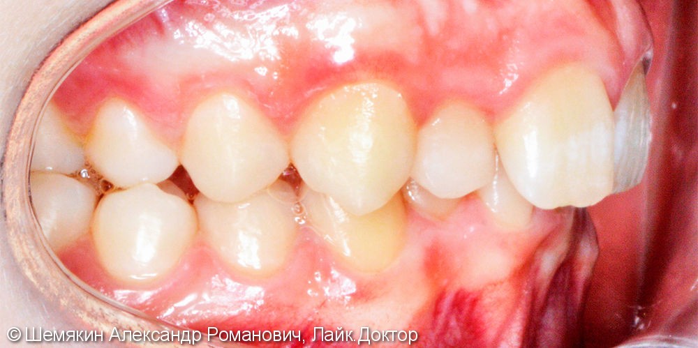 Исправление скученности зубов брекет системой Damon Q, до и результат после - фото №5