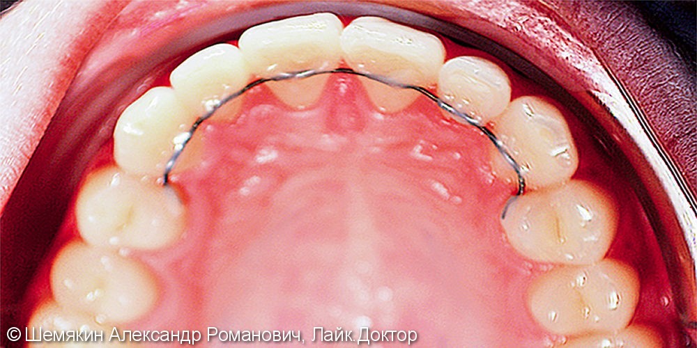 Исправление скученности зубов брекет системой Damon Q, до и результат после - фото №6