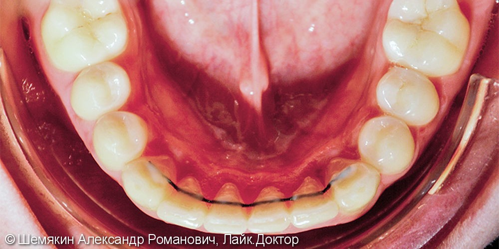 Исправление скученности зубов брекет системой Damon Q, до и результат после - фото №7