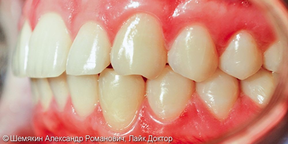 Исправление скученности зубов брекет системой Damon Q, до и результат после - фото №8