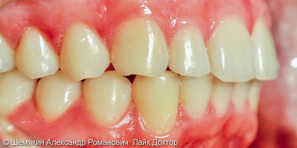 Исправление скученности зубов брекет системой Damon Q, до и результат после - фото №9